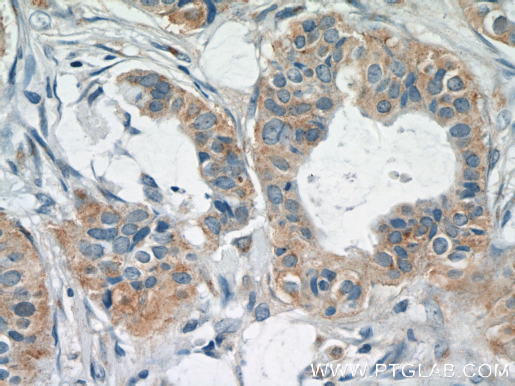 Immunohistochemistry (IHC) staining of human breast cancer tissue using TK1 Polyclonal antibody (15691-1-AP)