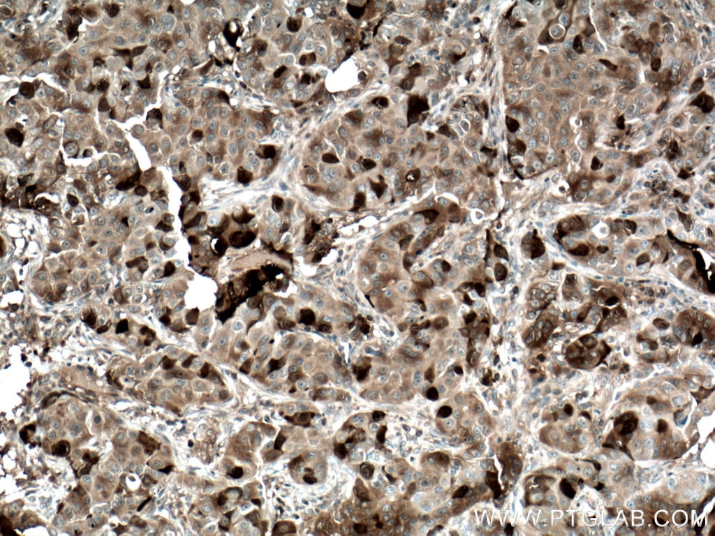 Immunohistochemistry (IHC) staining of human breast cancer tissue using TK1 Polyclonal antibody (15691-1-AP)