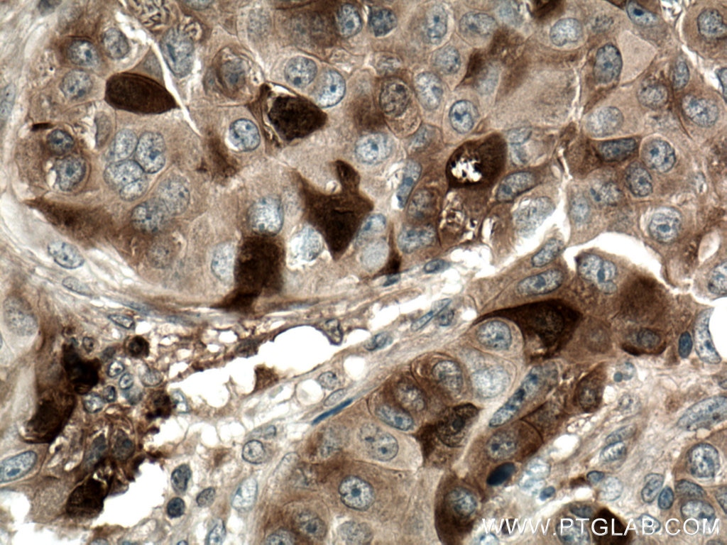 Immunohistochemistry (IHC) staining of human breast cancer tissue using TK1 Polyclonal antibody (15691-1-AP)