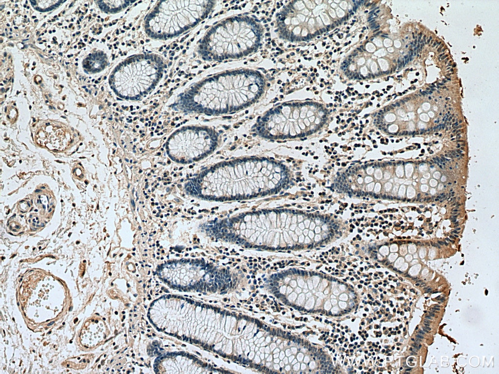 Immunohistochemistry (IHC) staining of human colon cancer tissue using TK1 Monoclonal antibody (67787-1-Ig)