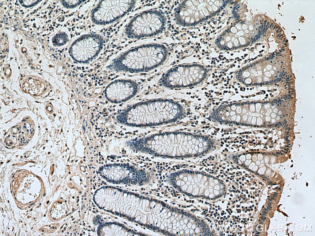 IHC staining of human colon cancer using 67787-1-Ig