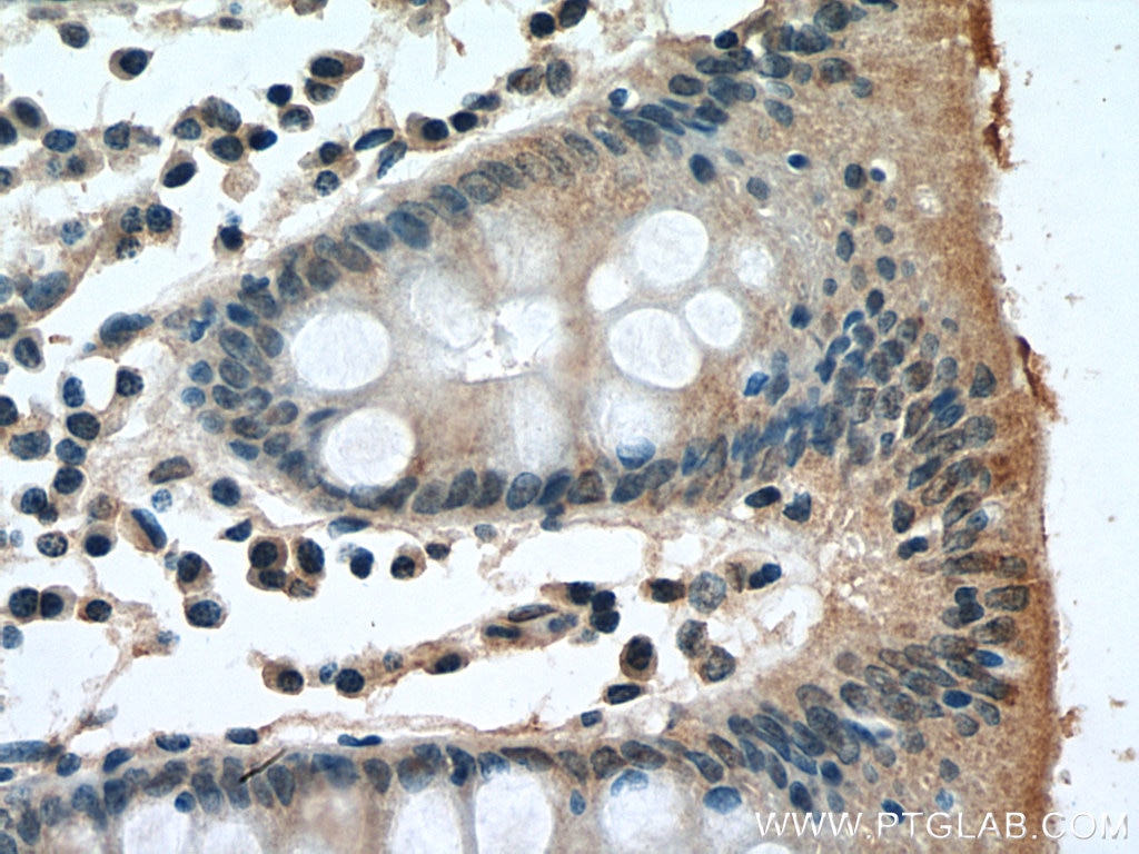 Immunohistochemistry (IHC) staining of human colon cancer tissue using TK1 Monoclonal antibody (67787-1-Ig)