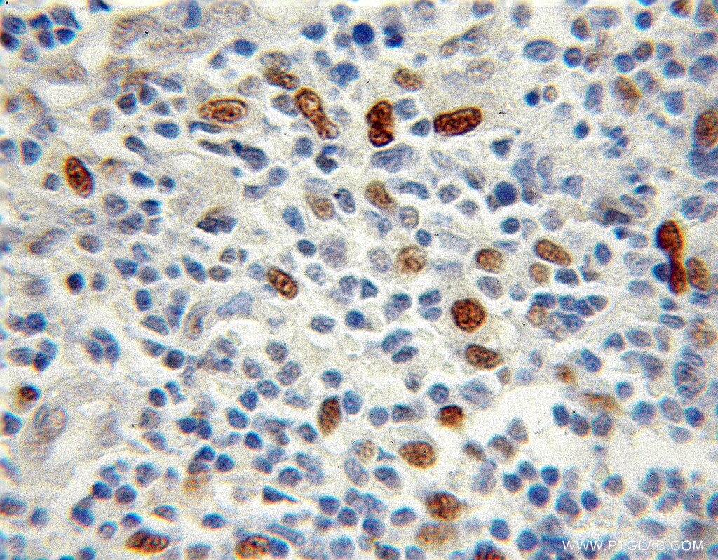 Immunohistochemistry (IHC) staining of human lymphoma tissue using Transketolase Polyclonal antibody (11039-1-AP)