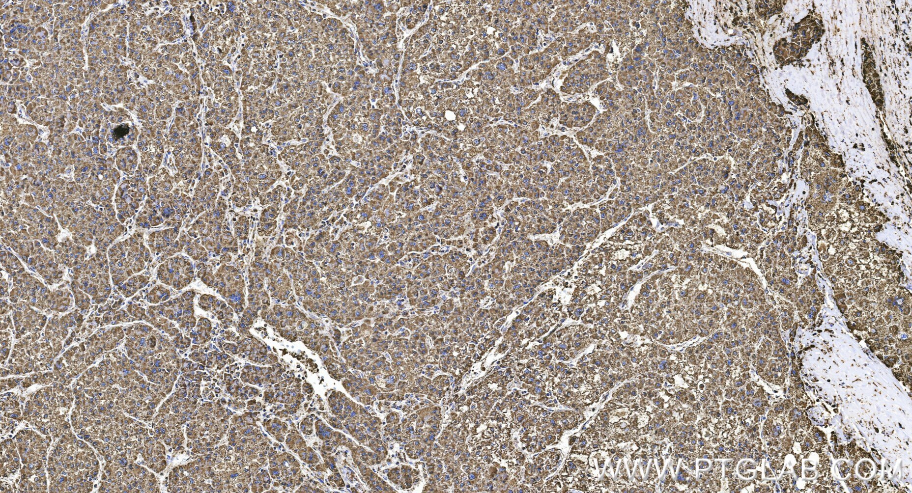 Immunohistochemical analysis of paraffin-embedded human liver cancer tissue slide using 85877-1-RR (TKTL1 antibody) at dilution of 1:1000 (under 20x lens). Heat mediated antigen retrieval with Tris-EDTA buffer (pH 9.0). Immunohistochemistry (IHC) staining of human liver cancer tissue using TKTL1 Recombinant monoclonal antibody (85877-1-RR)
