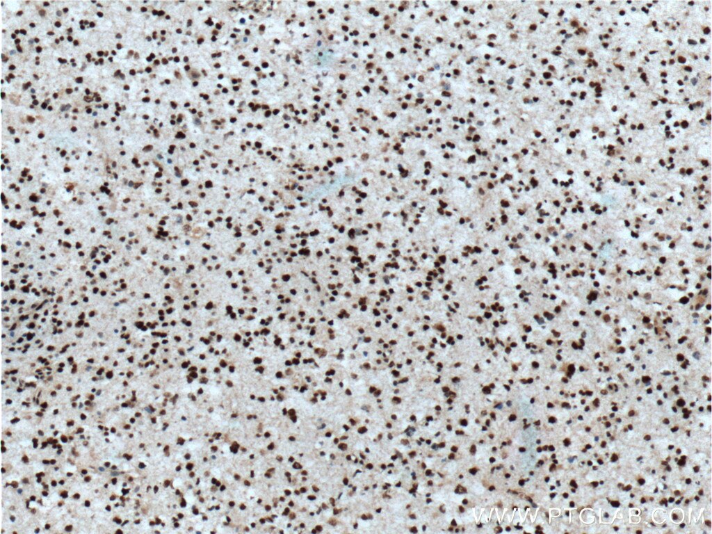 Immunohistochemistry (IHC) staining of human gliomas tissue using TLE1 Polyclonal antibody (11284-1-AP)
