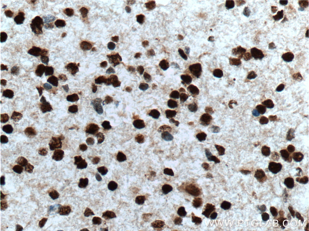 Immunohistochemistry (IHC) staining of human gliomas tissue using TLE1 Polyclonal antibody (11284-1-AP)