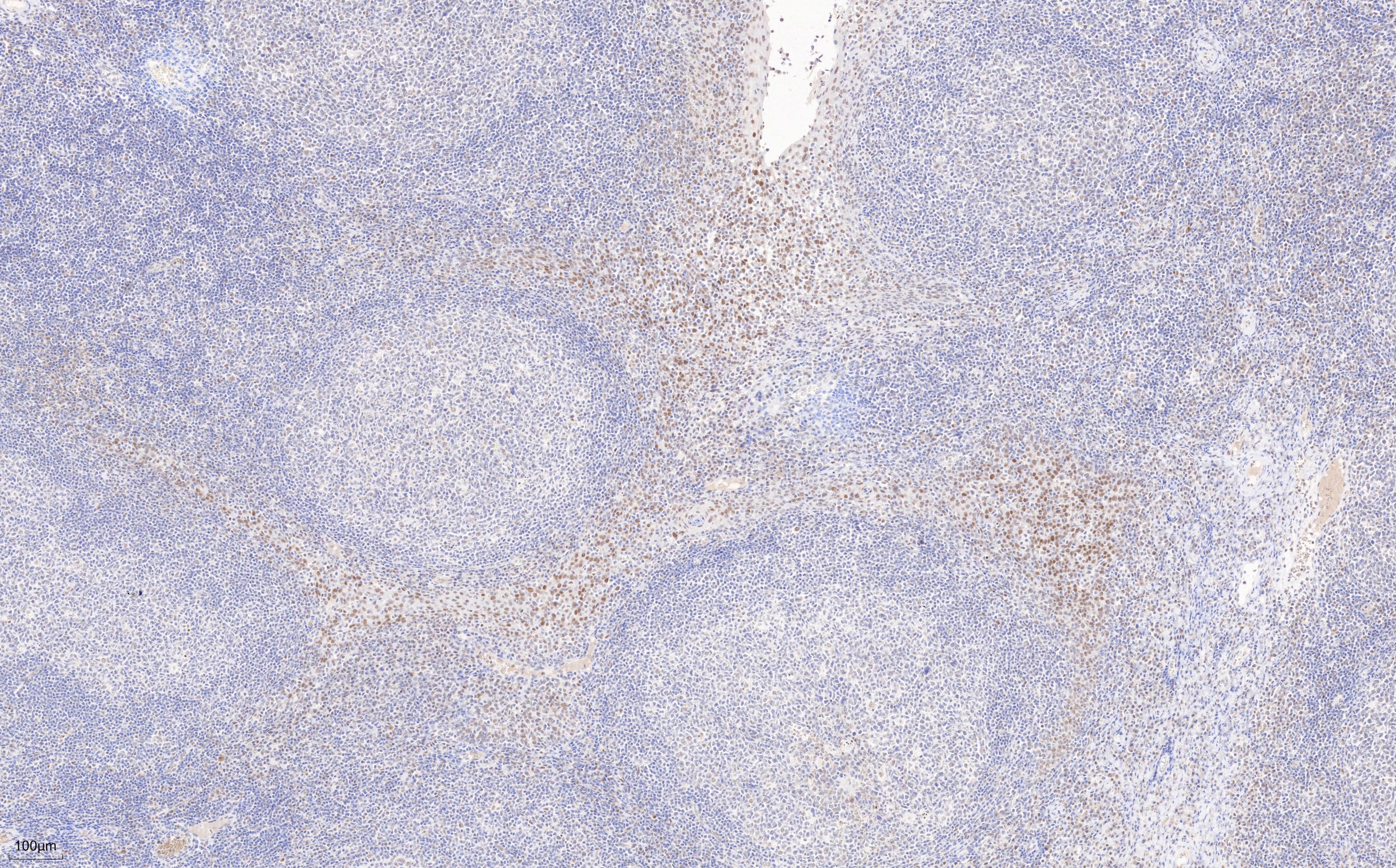 Immunohistochemistry (IHC) staining of human tonsillitis tissue using TLE1 Monoclonal antibody (66216-1-Ig)