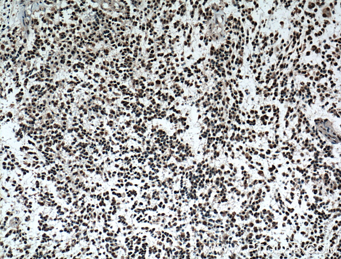 Immunohistochemistry (IHC) staining of human gliomas tissue using TLE1 Monoclonal antibody (66216-1-Ig)