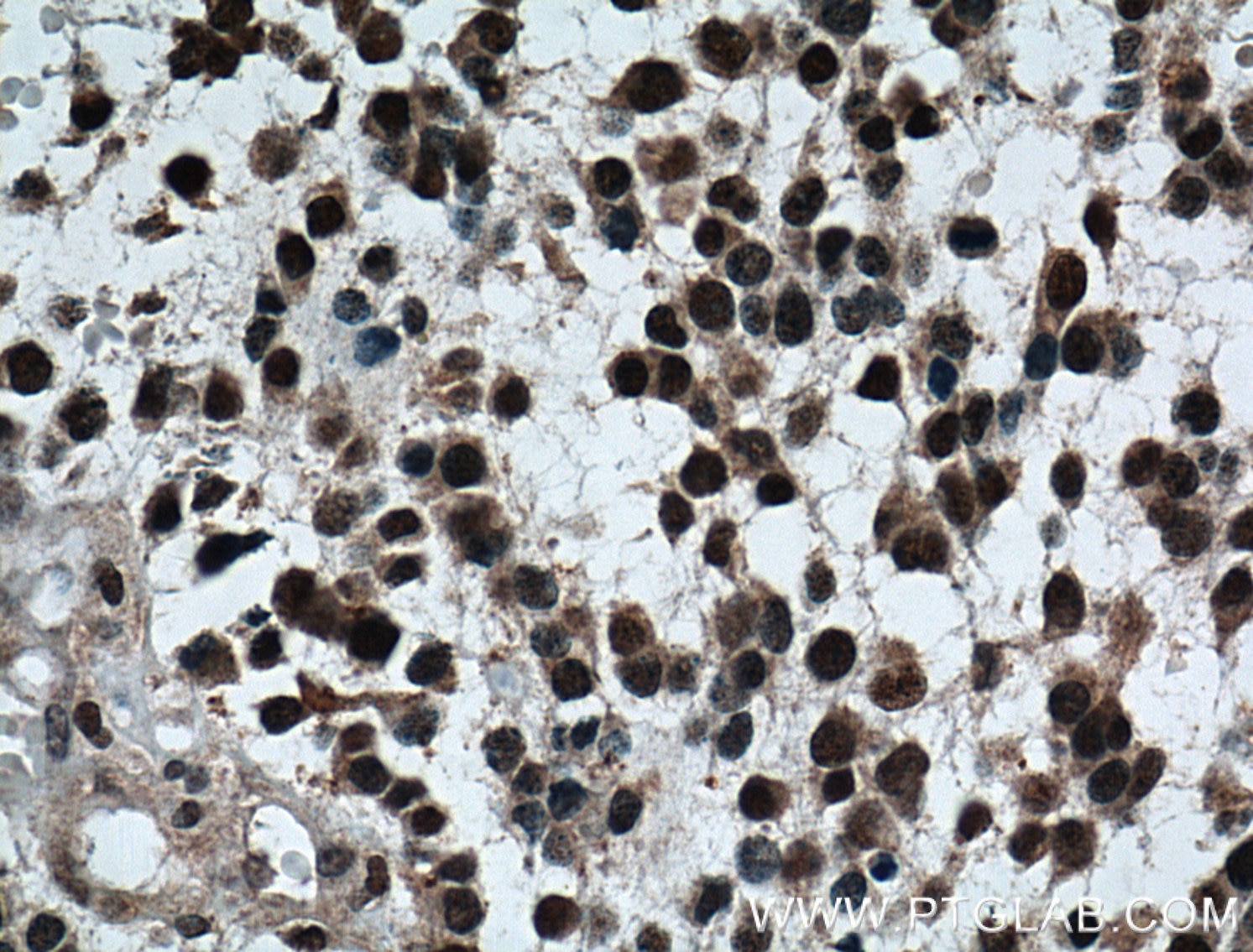 Immunohistochemistry (IHC) staining of human gliomas tissue using TLE1 Monoclonal antibody (66216-1-Ig)