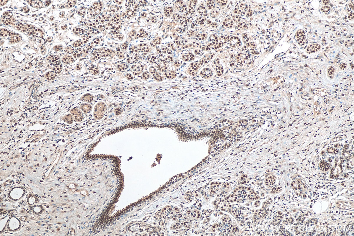 Immunohistochemistry (IHC) staining of human breast cancer tissue using TLE3 Polyclonal antibody (11372-1-AP)