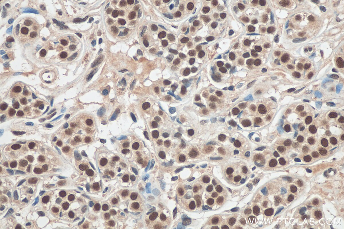 Immunohistochemistry (IHC) staining of human breast cancer tissue using TLE3 Polyclonal antibody (11372-1-AP)