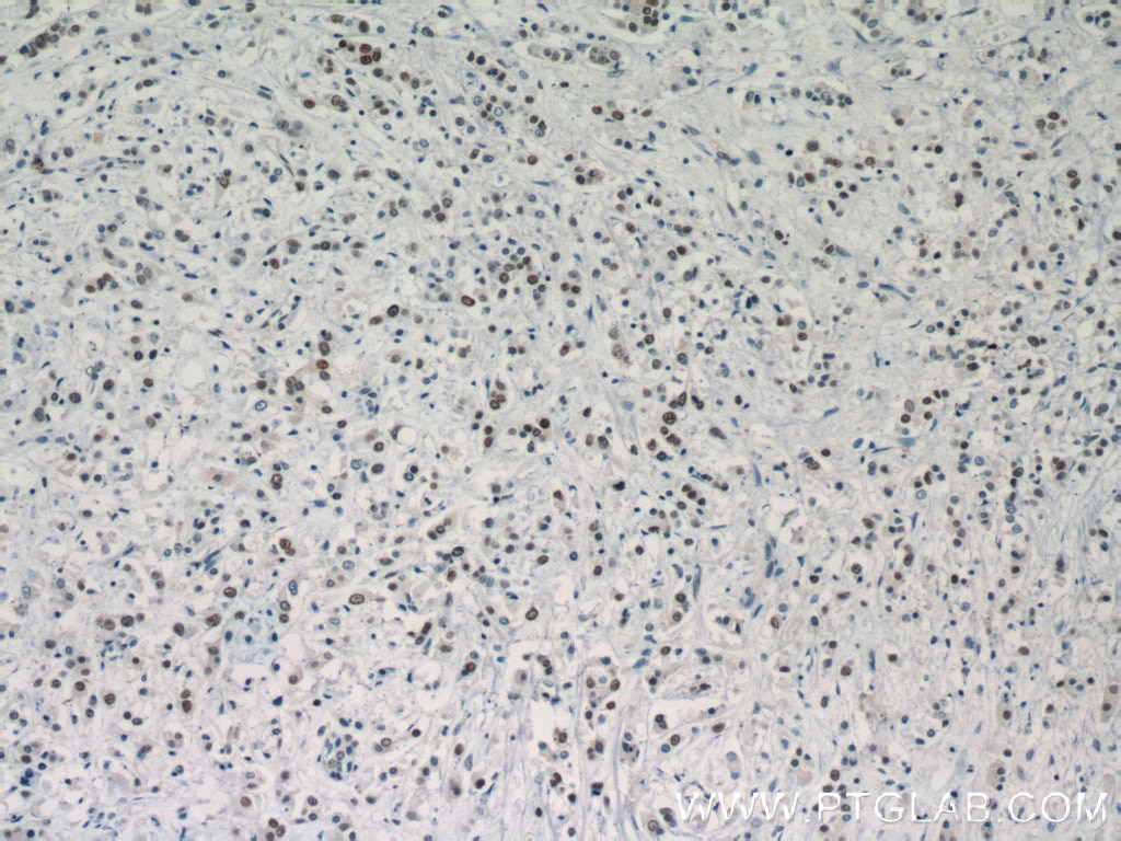 Immunohistochemistry (IHC) staining of human breast cancer tissue using TLE3 Polyclonal antibody (11372-1-AP)