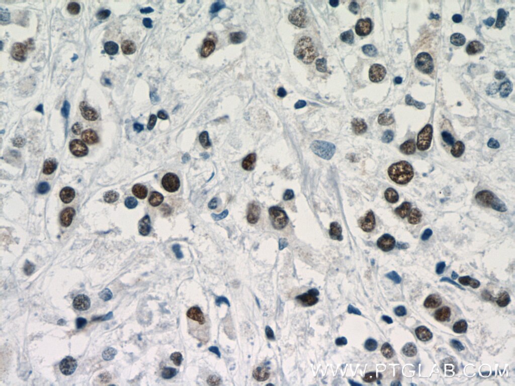 Immunohistochemistry (IHC) staining of human breast cancer tissue using TLE3 Polyclonal antibody (11372-1-AP)
