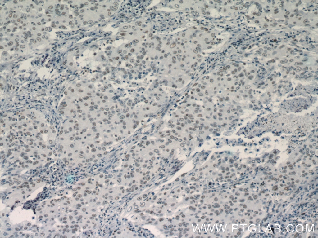 Immunohistochemistry (IHC) staining of human lung cancer tissue using TLE3 Polyclonal antibody (11372-1-AP)