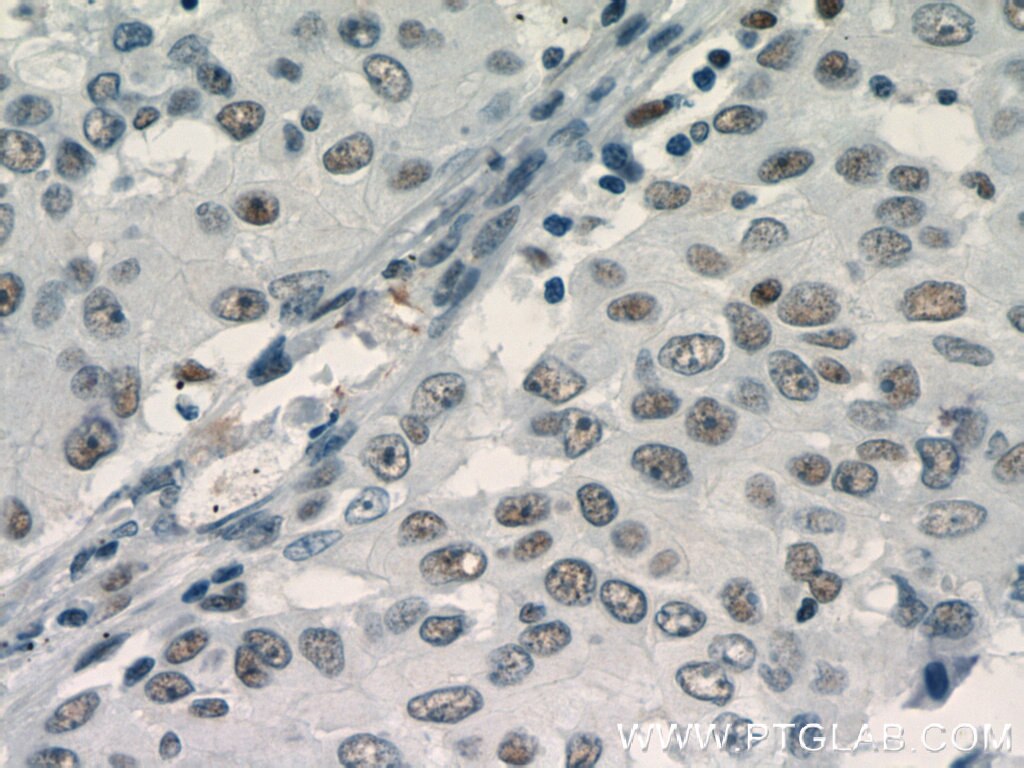 Immunohistochemistry (IHC) staining of human lung cancer tissue using TLE3 Polyclonal antibody (11372-1-AP)
