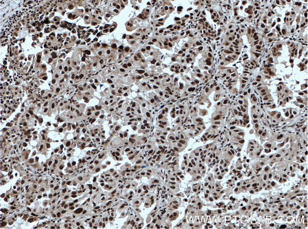 Immunohistochemistry (IHC) staining of human lung cancer tissue using TLE3 Polyclonal antibody (22094-1-AP)
