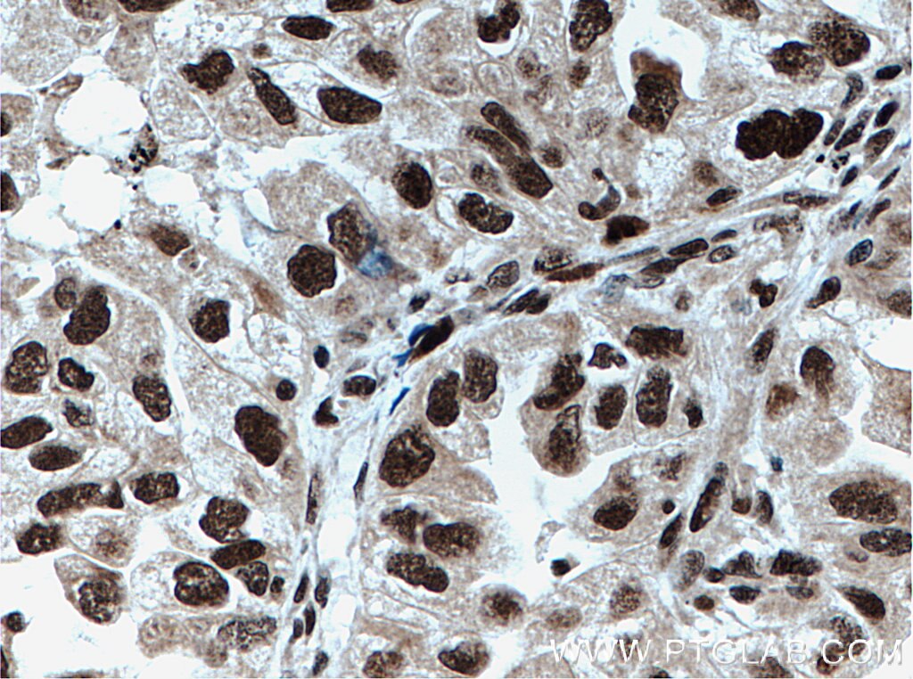 Immunohistochemistry (IHC) staining of human lung cancer tissue using TLE3 Polyclonal antibody (22094-1-AP)