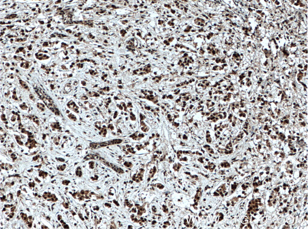 Immunohistochemistry (IHC) staining of human breast cancer tissue using TLE3 Polyclonal antibody (22094-1-AP)