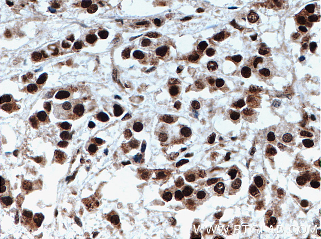 Immunohistochemistry (IHC) staining of human breast cancer tissue using TLE3 Polyclonal antibody (22094-1-AP)