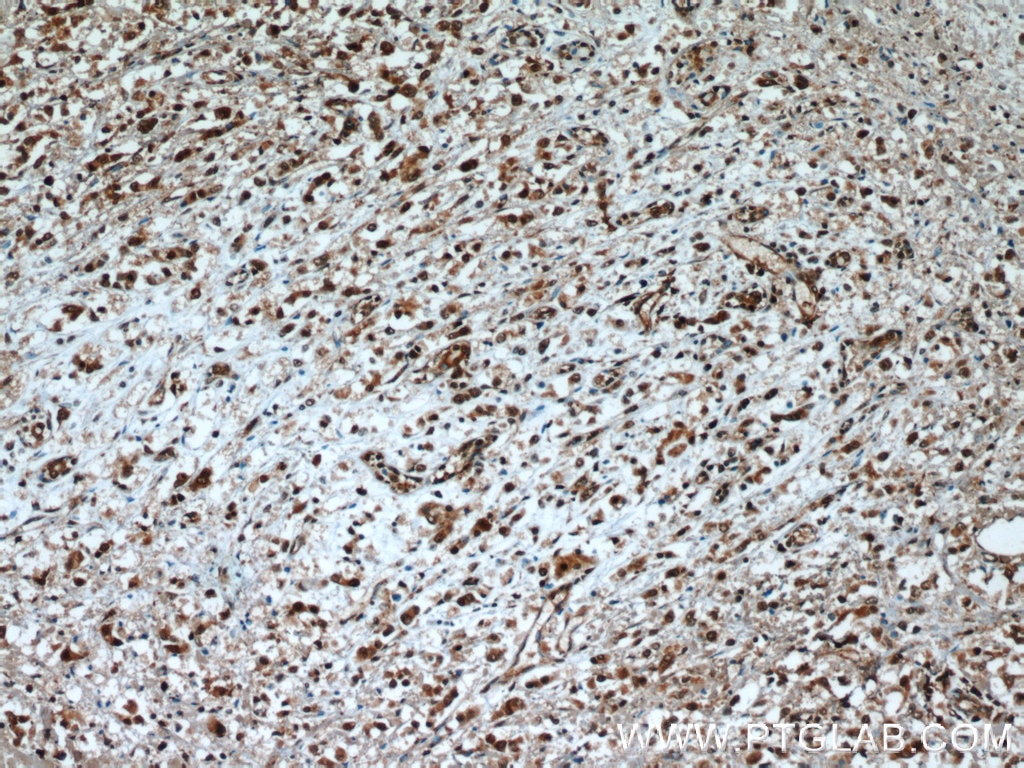 Immunohistochemistry (IHC) staining of human breast cancer tissue using TLE3 Monoclonal antibody (66083-1-Ig)