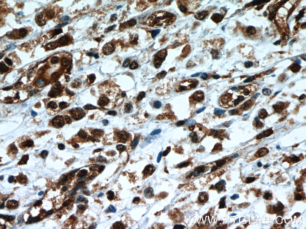 Immunohistochemistry (IHC) staining of human breast cancer tissue using TLE3 Monoclonal antibody (66083-1-Ig)