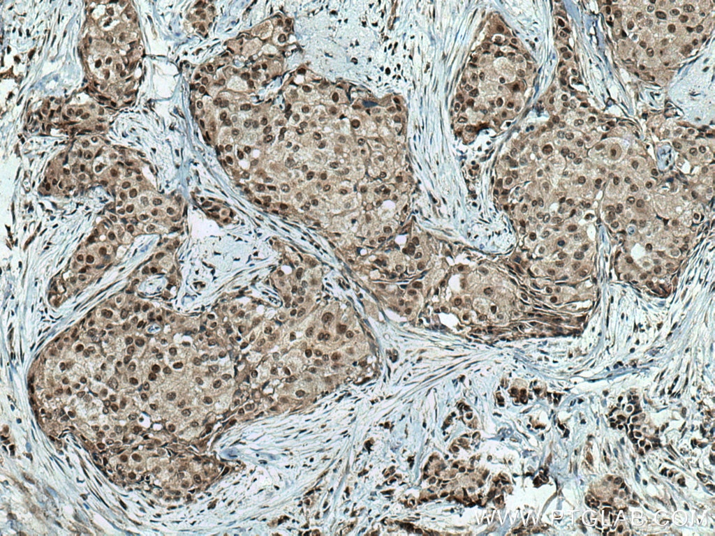 Immunohistochemistry (IHC) staining of human breast cancer tissue using TLK2 Polyclonal antibody (13979-1-AP)