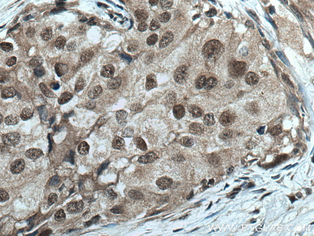 Immunohistochemistry (IHC) staining of human breast cancer tissue using TLK2 Polyclonal antibody (13979-1-AP)