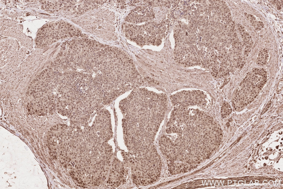 Immunohistochemistry (IHC) staining of human stomach cancer tissue using TLK2 Polyclonal antibody (13979-1-AP)