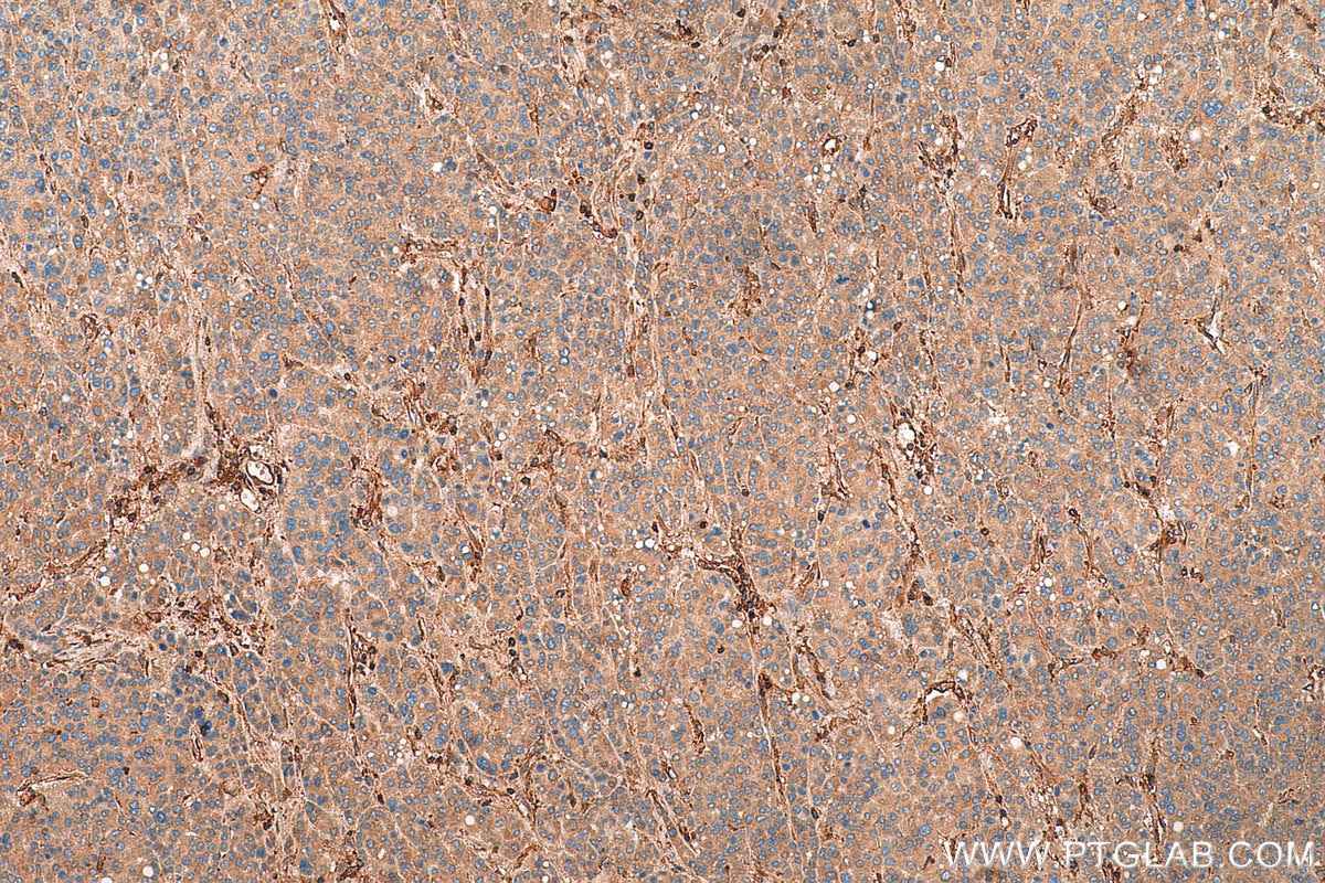 IHC staining of human liver cancer using 14168-1-AP