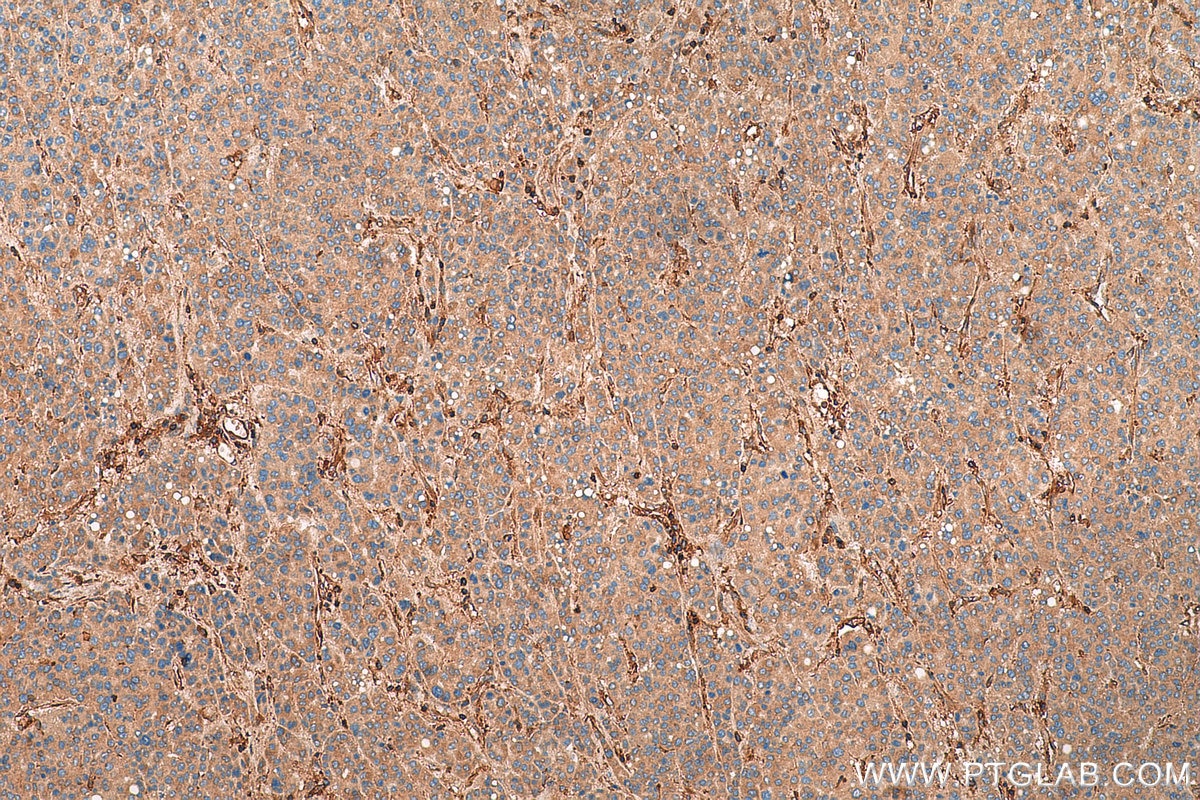 Immunohistochemistry (IHC) staining of human liver cancer tissue using Talin-1 Polyclonal antibody (14168-1-AP)