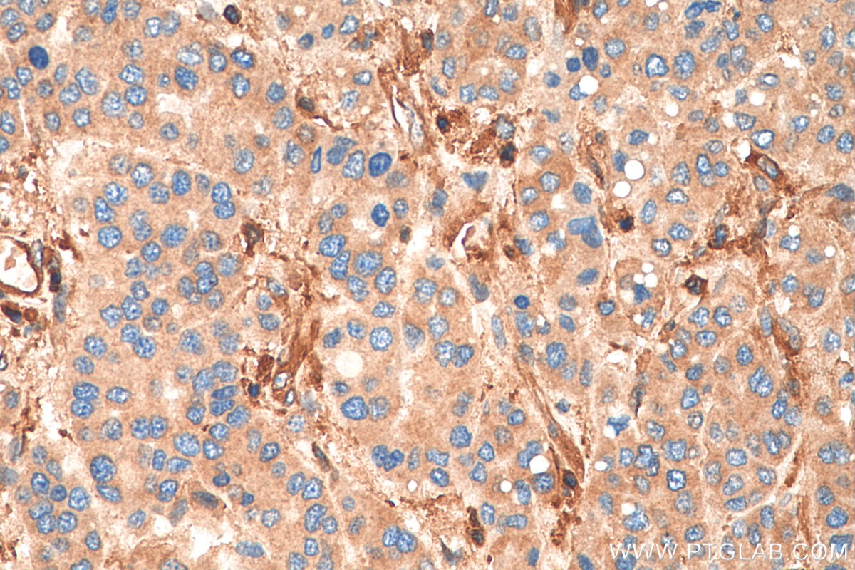 Immunohistochemistry (IHC) staining of human liver cancer tissue using Talin-1 Polyclonal antibody (14168-1-AP)