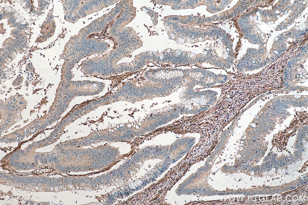 Immunohistochemistry (IHC) staining of human colon cancer tissue using Talin-1 Monoclonal antibody (67992-1-Ig)