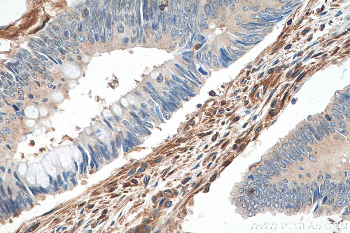 IHC staining of human colon cancer using 67992-1-Ig