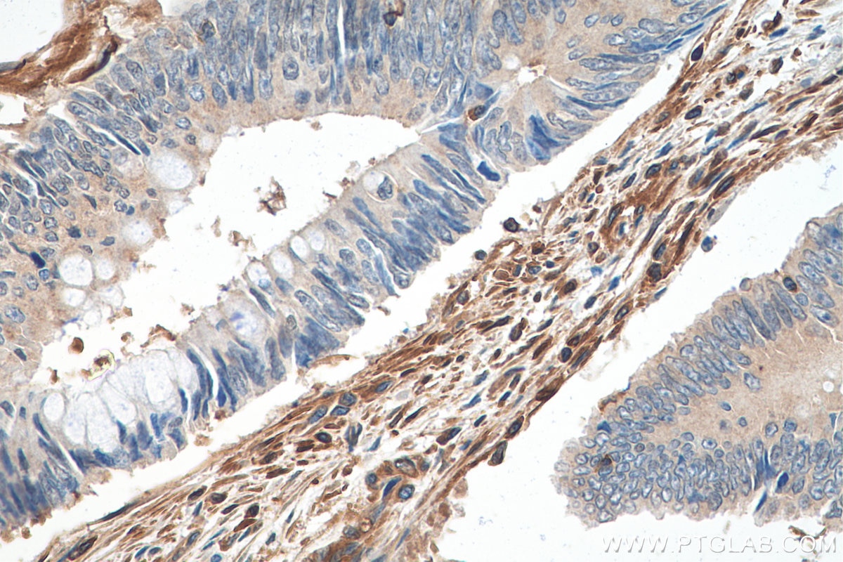 Immunohistochemistry (IHC) staining of human colon cancer tissue using Talin-1 Monoclonal antibody (67992-1-Ig)