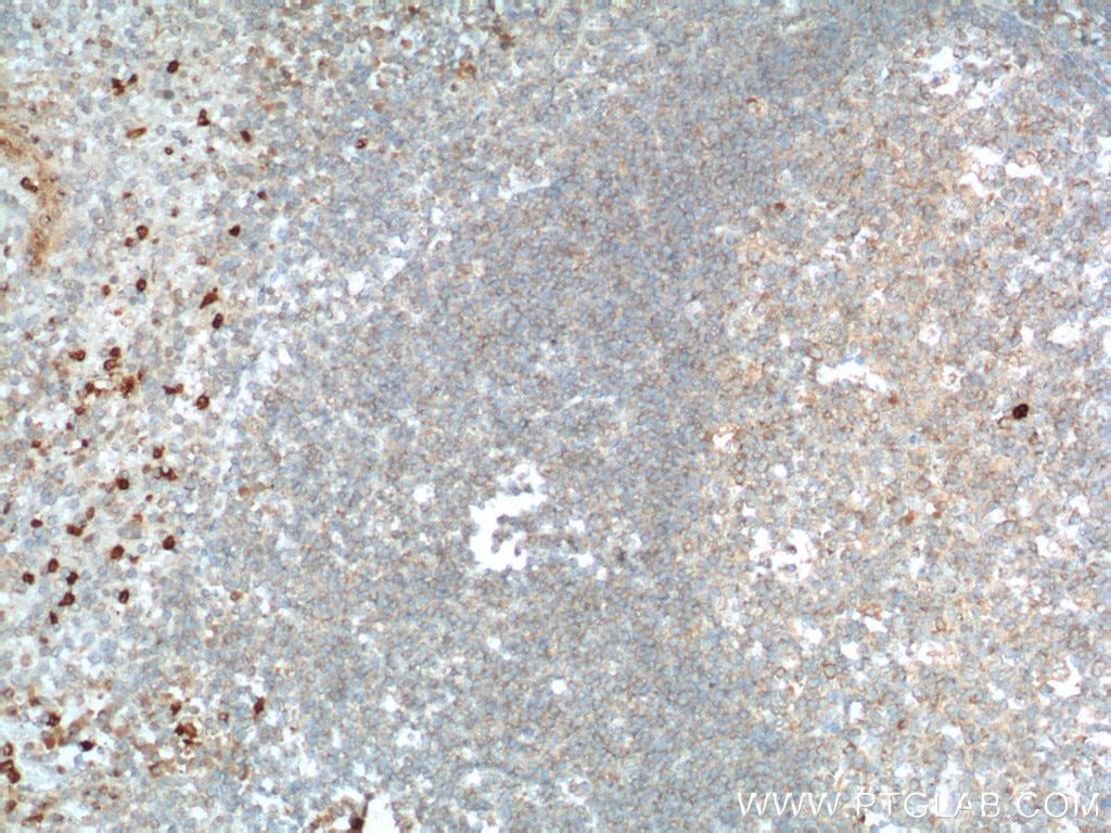 Immunohistochemistry (IHC) staining of human tonsillitis tissue using TLR1 Polyclonal antibody (19816-1-AP)