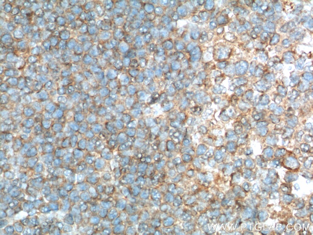 Immunohistochemistry (IHC) staining of human tonsillitis tissue using TLR1 Polyclonal antibody (19816-1-AP)