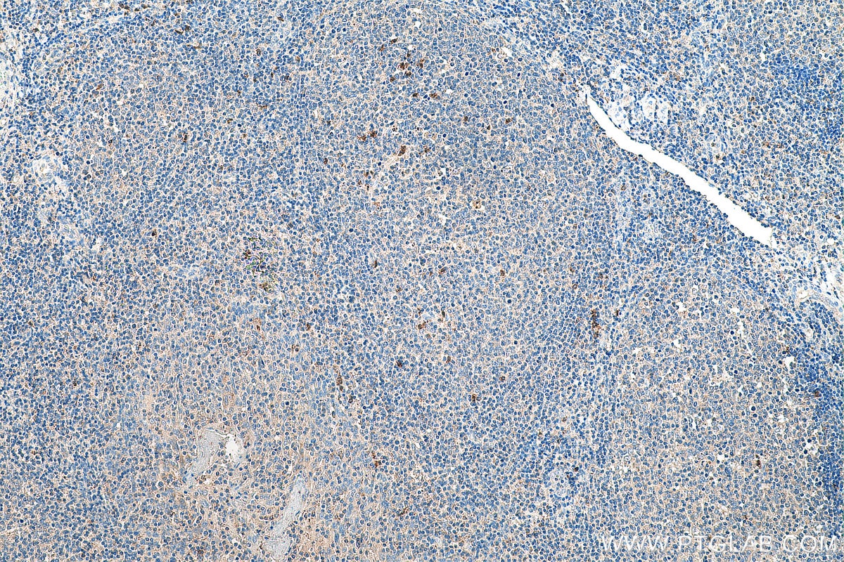 Immunohistochemistry (IHC) staining of human tonsillitis tissue using TLR2 Polyclonal antibody (17236-1-AP)