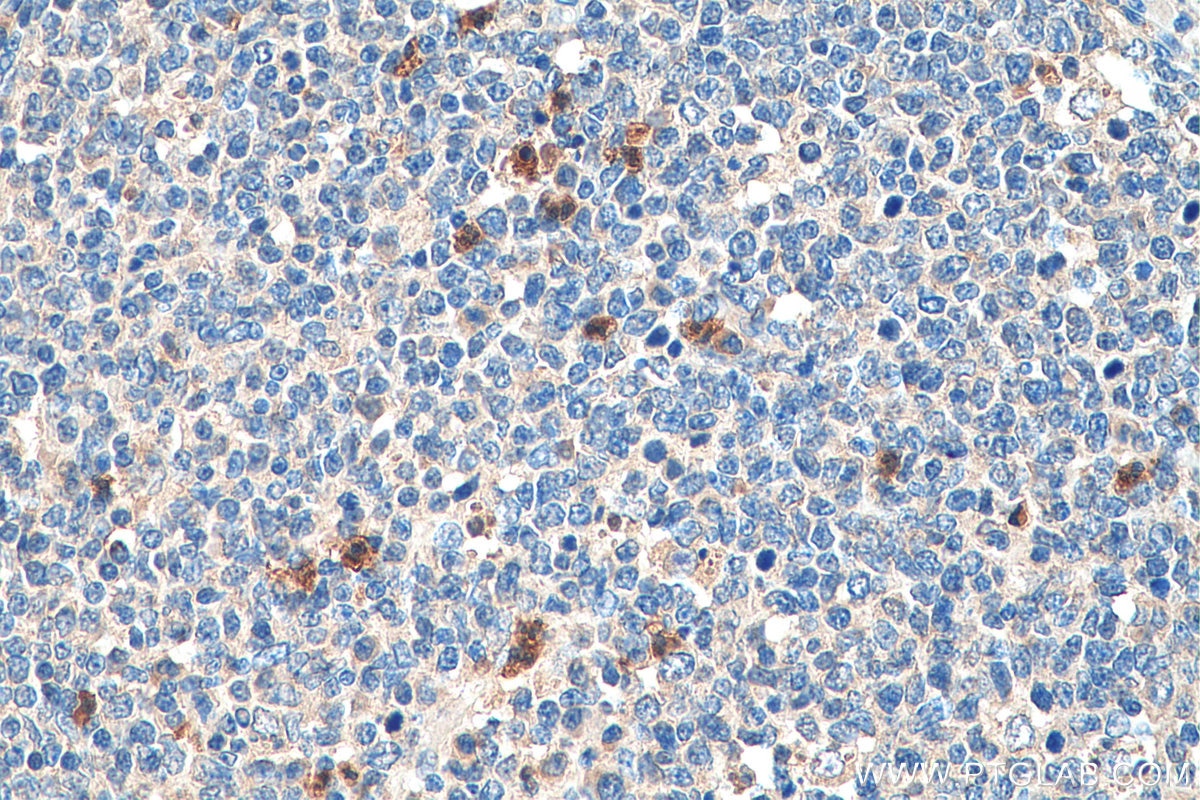 Immunohistochemistry (IHC) staining of human tonsillitis tissue using TLR2 Polyclonal antibody (17236-1-AP)