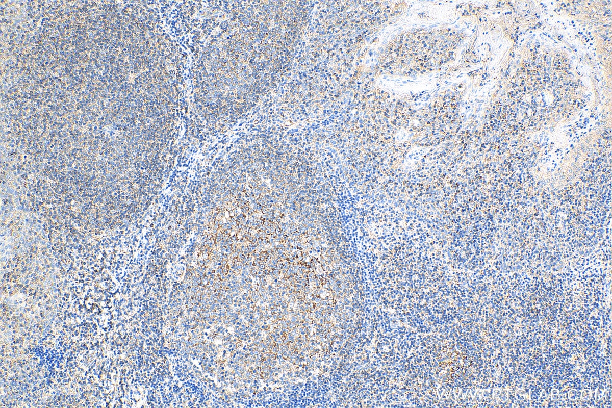 Immunohistochemistry (IHC) staining of human tonsillitis tissue using TLR3 Polyclonal antibody (17766-1-AP)