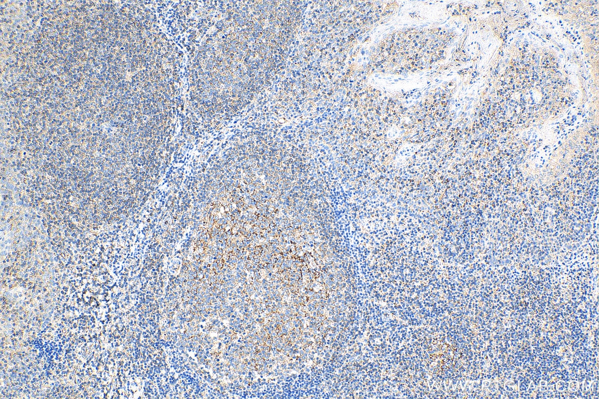 IHC staining of human tonsillitis using 17766-1-AP