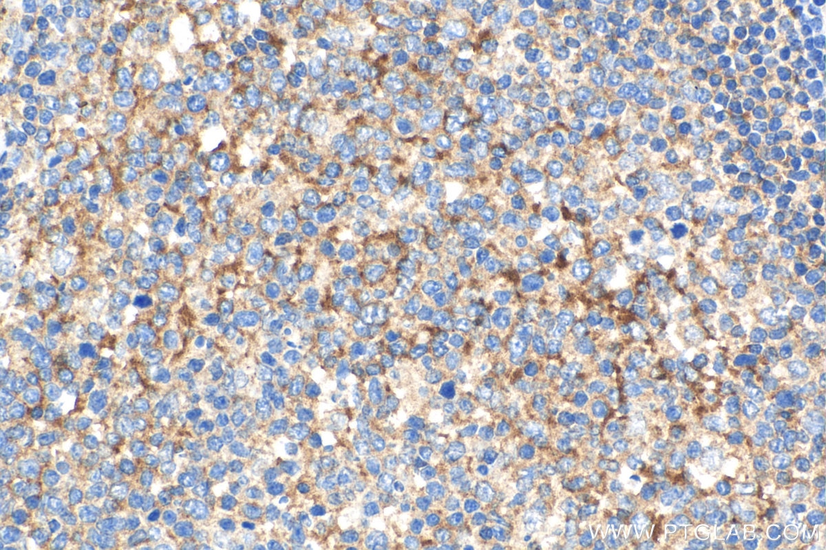 Immunohistochemistry (IHC) staining of human tonsillitis tissue using TLR3 Polyclonal antibody (17766-1-AP)