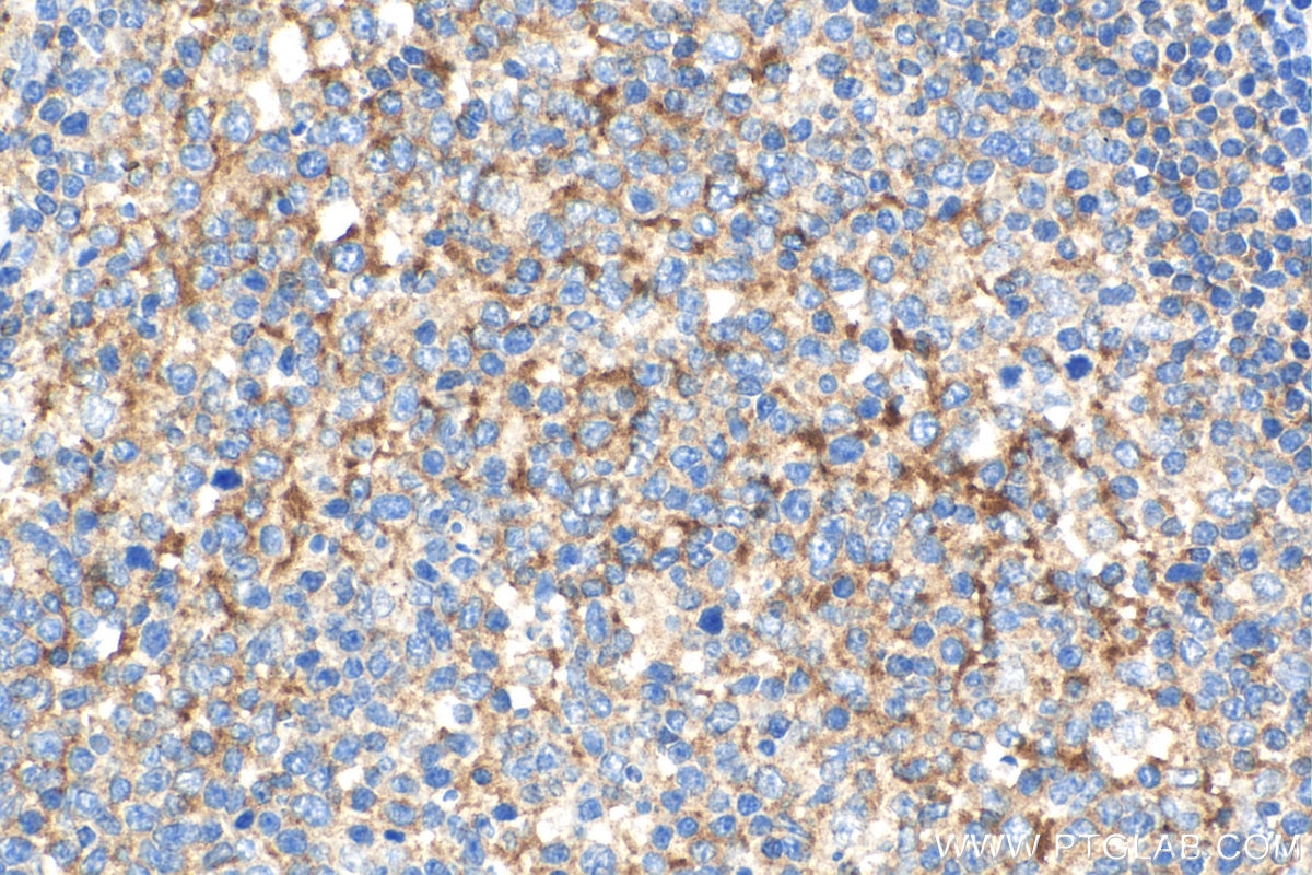 IHC staining of human tonsillitis using 17766-1-AP