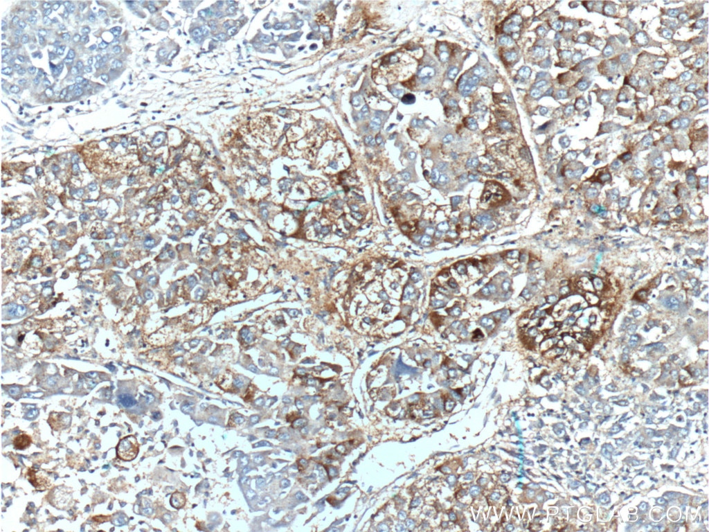 Immunohistochemistry (IHC) staining of human liver cancer tissue using TLR4 Polyclonal antibody (19811-1-AP)