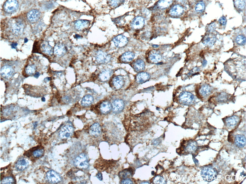Immunohistochemistry (IHC) staining of human liver cancer tissue using TLR4 Polyclonal antibody (19811-1-AP)