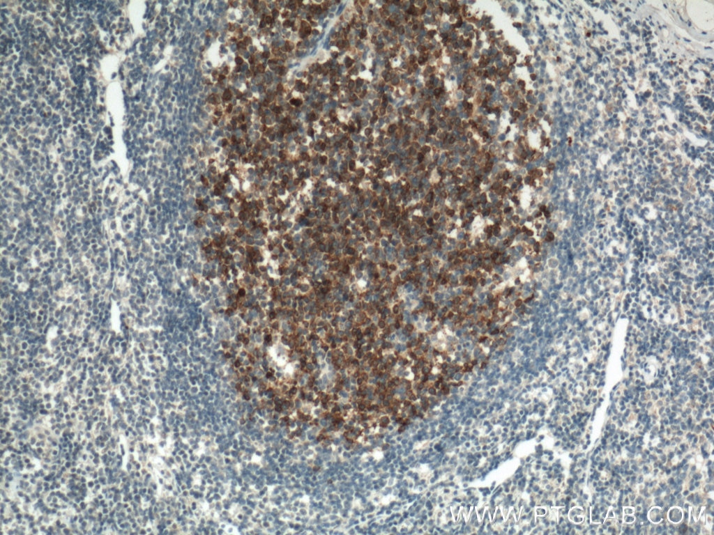 Immunohistochemistry (IHC) staining of human tonsillitis tissue using TLR4 Monoclonal antibody (66350-1-Ig)