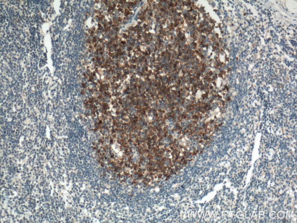 IHC staining of human tonsillitis using 66350-1-Ig