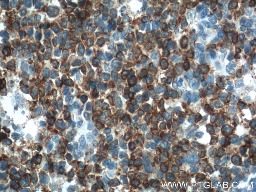 Immunohistochemistry (IHC) staining of human tonsillitis tissue using TLR4 Monoclonal antibody (66350-1-Ig)