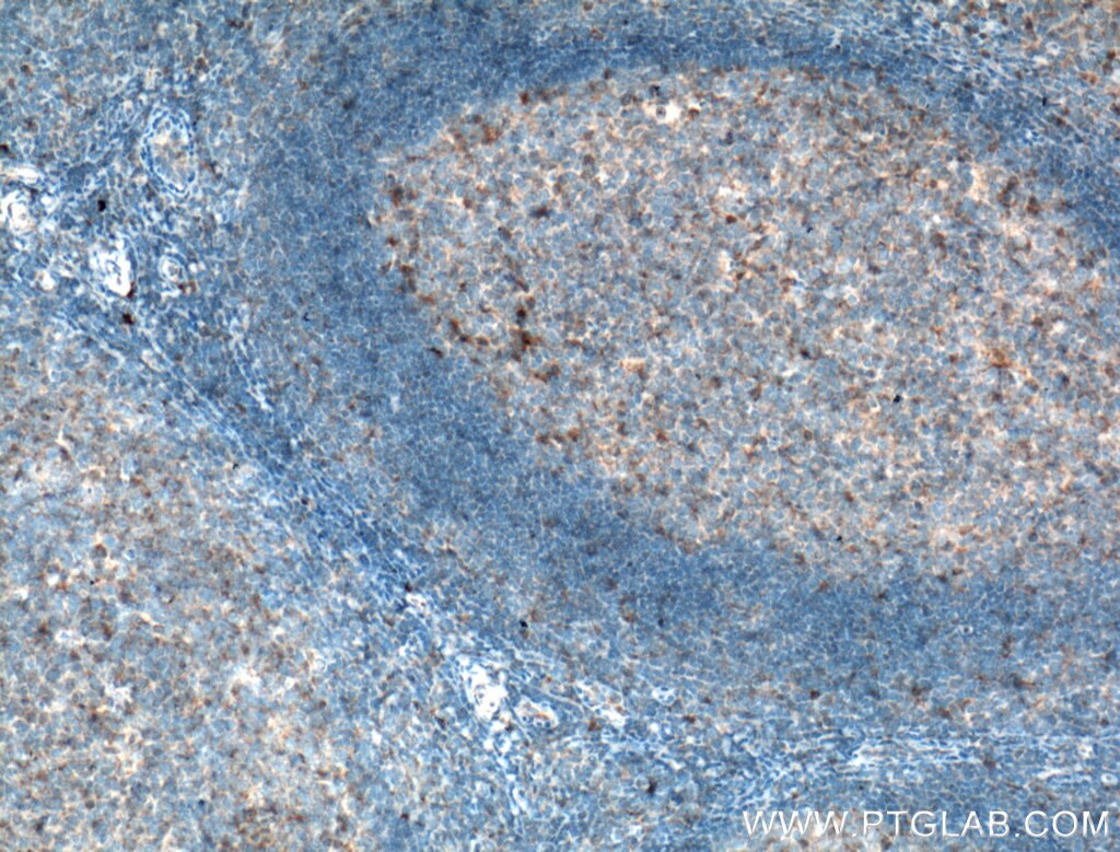 Immunohistochemistry (IHC) staining of human tonsillitis tissue using TLR5 Polyclonal antibody (19810-1-AP)