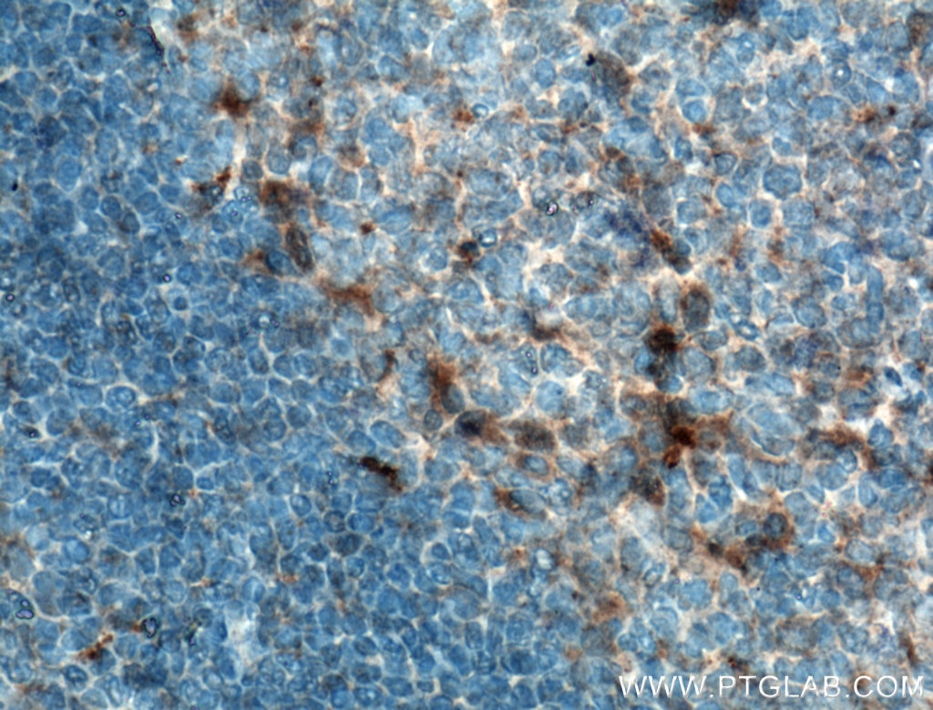 IHC staining of human tonsillitis using 19810-1-AP