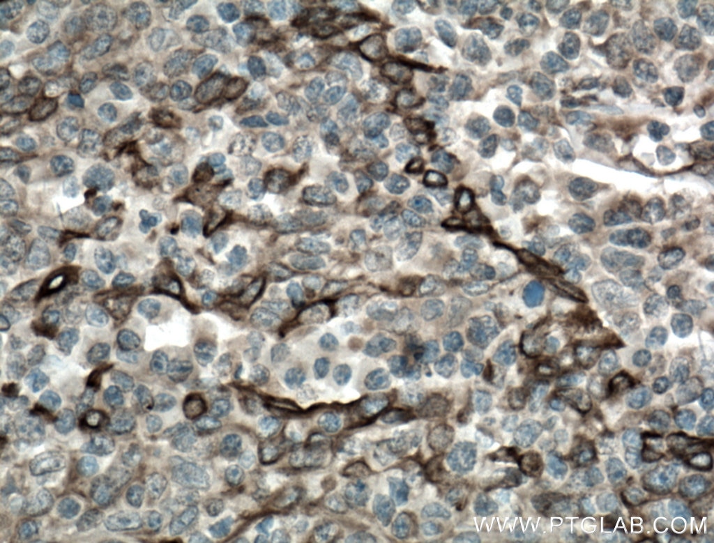 Immunohistochemistry (IHC) staining of human tonsillitis tissue using TLR8 Monoclonal antibody (67317-1-Ig)